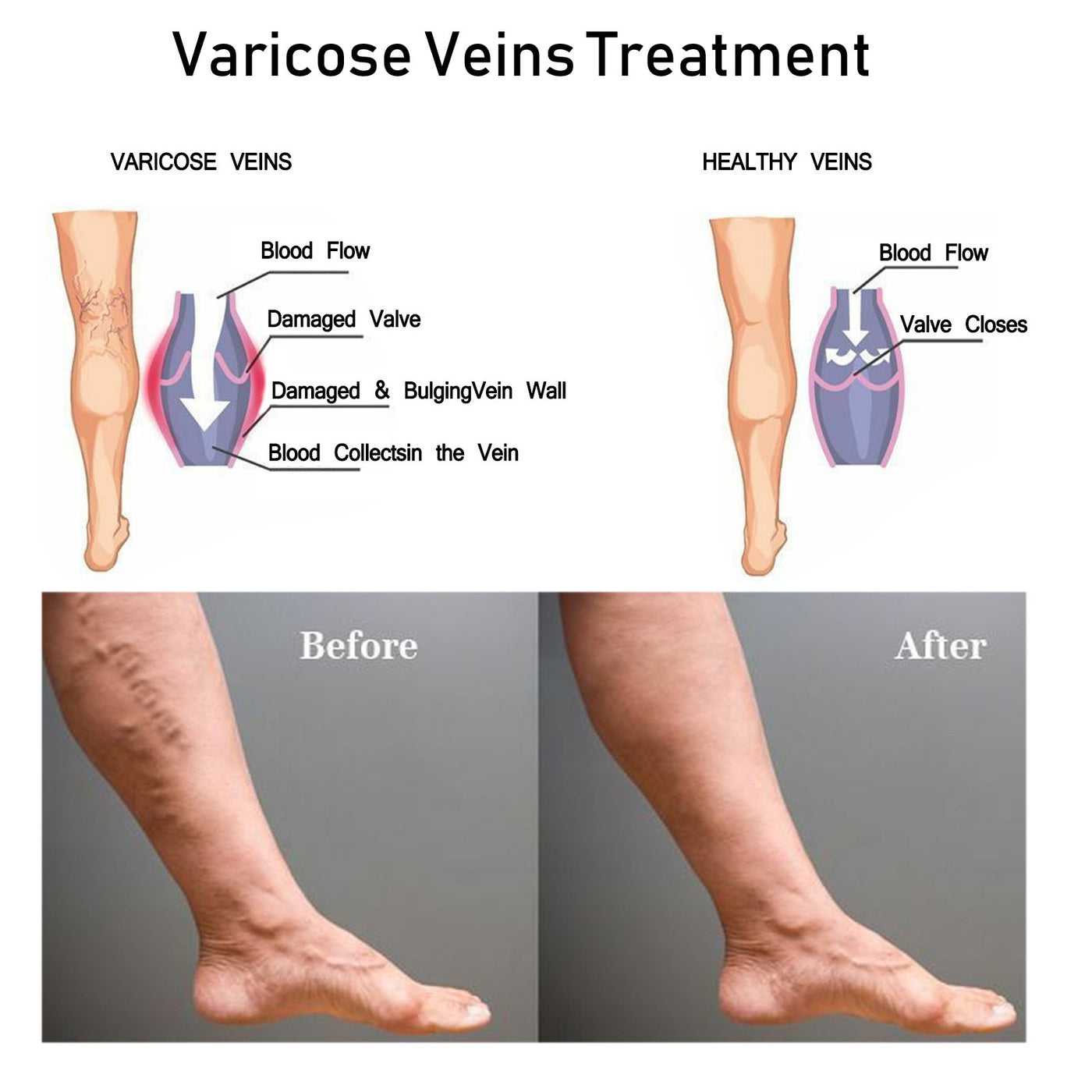 Venous Repair Cream To Ease The Veins Massage