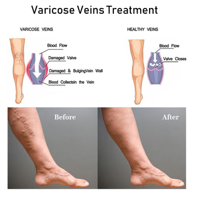 Venous Repair Cream To Ease The Veins Massage