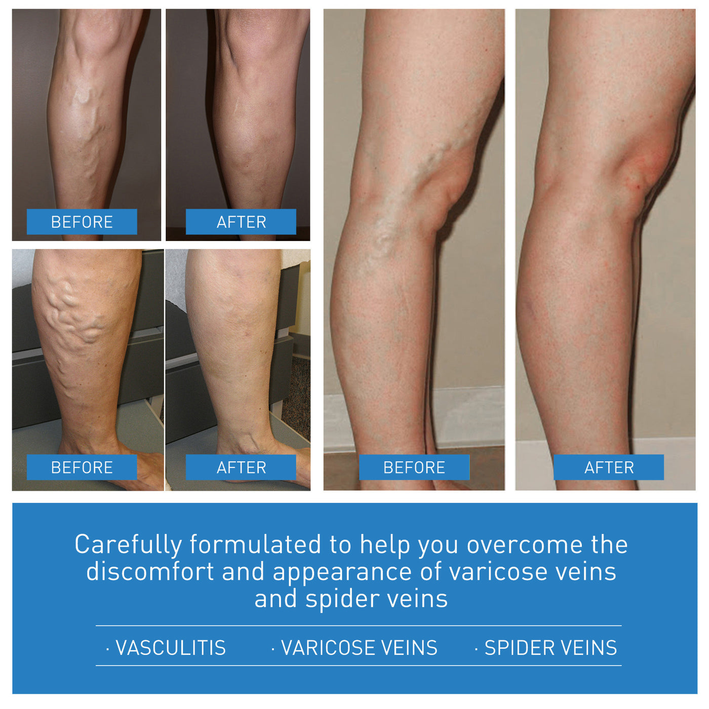 Venous Repair Cream To Ease The Veins Massage