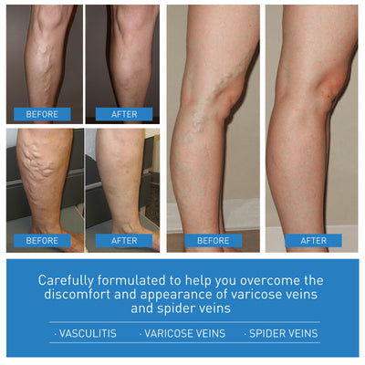 Venous Repair Cream To Ease The Veins Massage